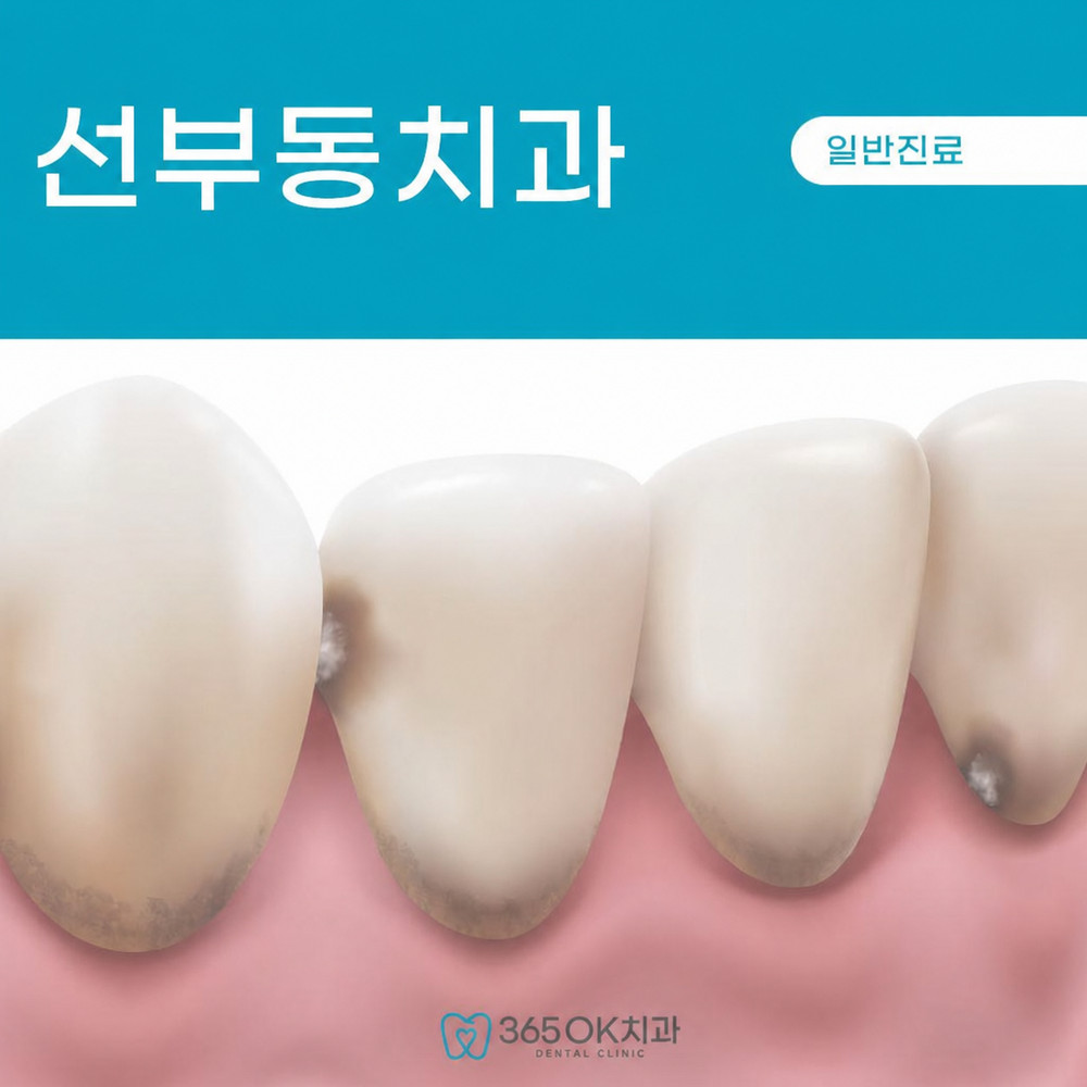 선부동치과 충치치료 필요 시기와 차갑거나 단 음식 시림 반복 불편함 주의사항