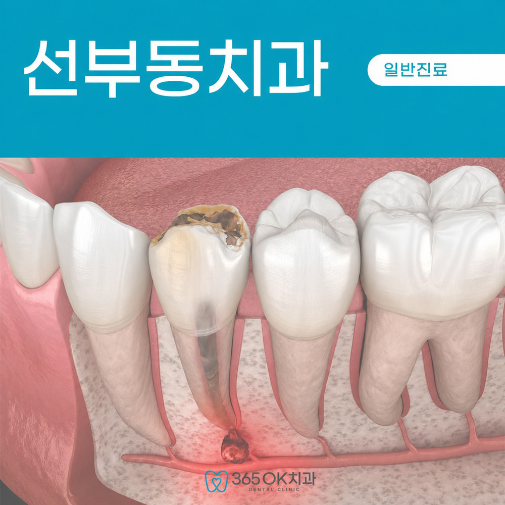 선부동치과 깊어진 충치 의심 증상과 가만히 있어도 이어지는 통증 변화 및 내원 기준