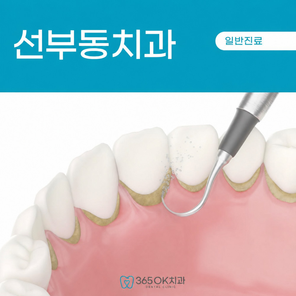 선부동치과 스케일링 추천 이유 치석과 플라그 제거와 잇몸질환 예방 효과