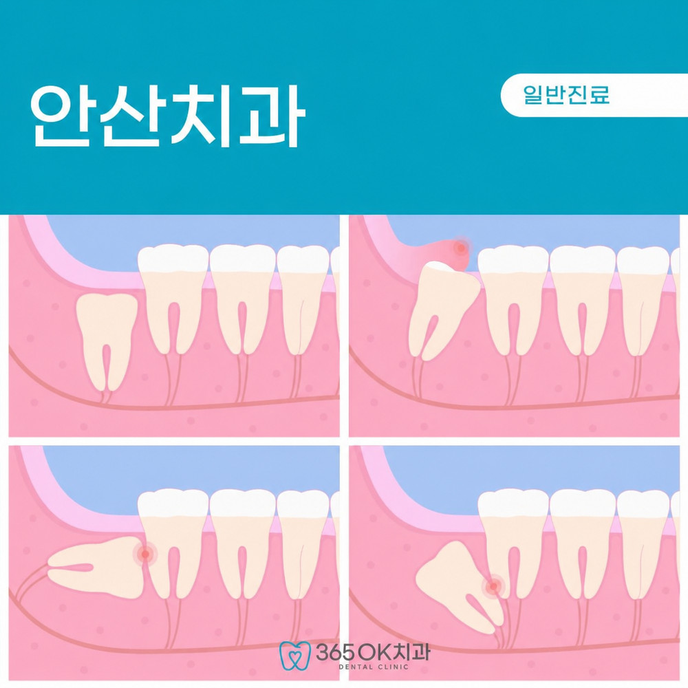안산치과 사랑니 통증 없어도 방치하면 염증과 주변 치아 손상 주의 필요성