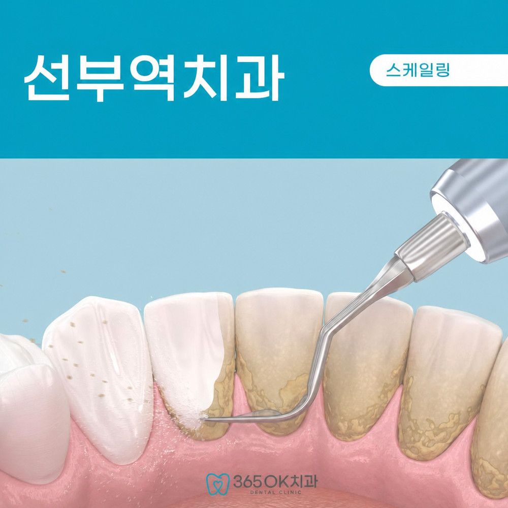 선부역치과 스케일링 1년에 한 번 이상 통증 없어도 미루면 안 되는 이유