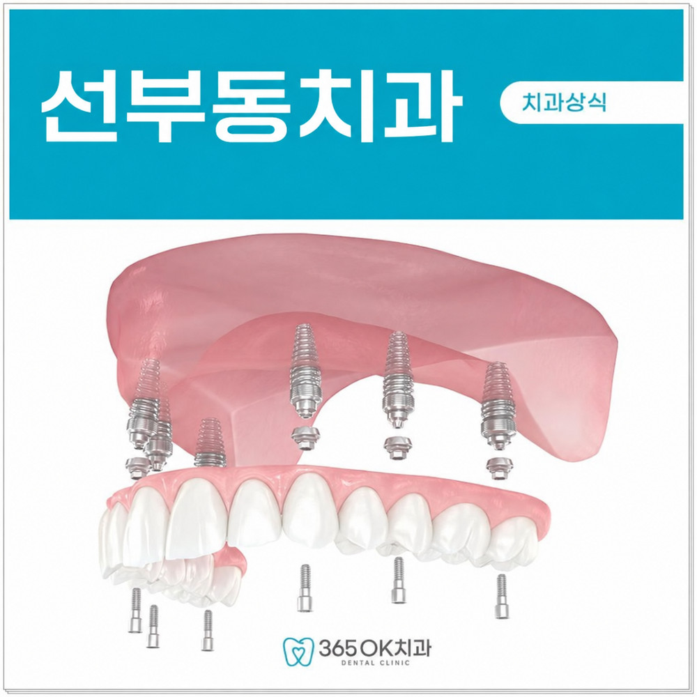 임플란트 틀니를 착용한 환자의 구강 상태를 선부동치과에서 점검